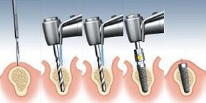 Implant Placement Surgery 