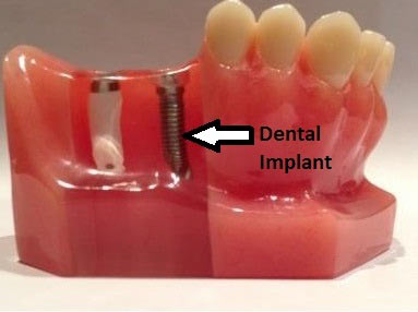 dental-impant