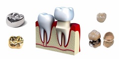 Porcelain Fused To Metal is Another Type of Crown