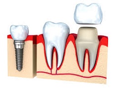 Base Metal Alloy Crown