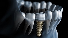 Learn More About Dental Implant Surgery