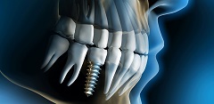 What Changes The Cost Of Dental Implant Treatment?