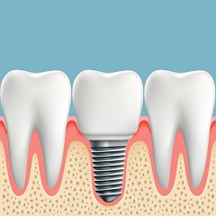 The Price of Dental Implants Can Vary Widely