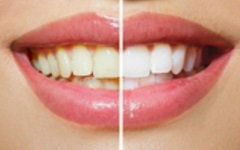 Teeth Whitening - Before and After
