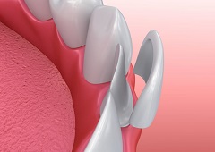 The Advantages of Dental Veneers