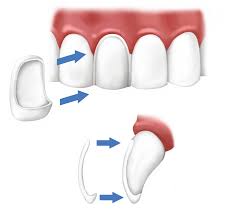 Veneers Are Highly Resistant To Staining